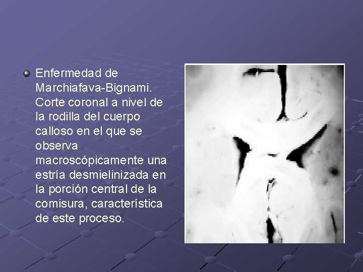 Enfermedad de Marchiafava-Bignami. Corte coronal a nivel de la rodilla del cuerpo calloso en Enfermedad de Marchiafava-Bignami. Corte coronal a nivel de la rodilla del cuerpo calloso en