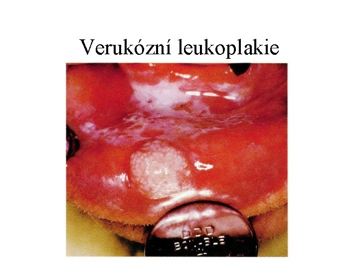 Verukózní leukoplakie 