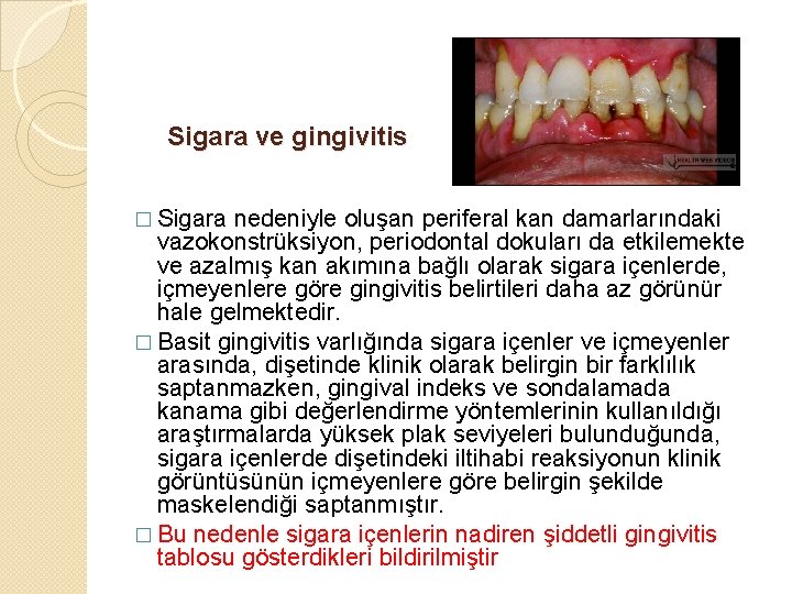 Sigara ve gingivitis � Sigara nedeniyle oluşan periferal kan damarlarındaki vazokonstrüksiyon, periodontal dokuları da