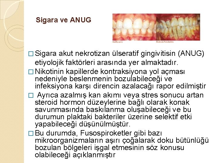 Sigara ve ANUG � Sigara akut nekrotizan ülseratif gingivitisin (ANUG) etiyolojik faktörleri arasında yer