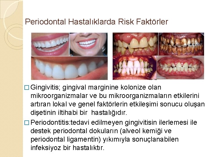 Periodontal Hastalıklarda Risk Faktörler � Gingivitis; gingival marginine kolonize olan mikroorganizmalar ve bu mikroorganizmaların