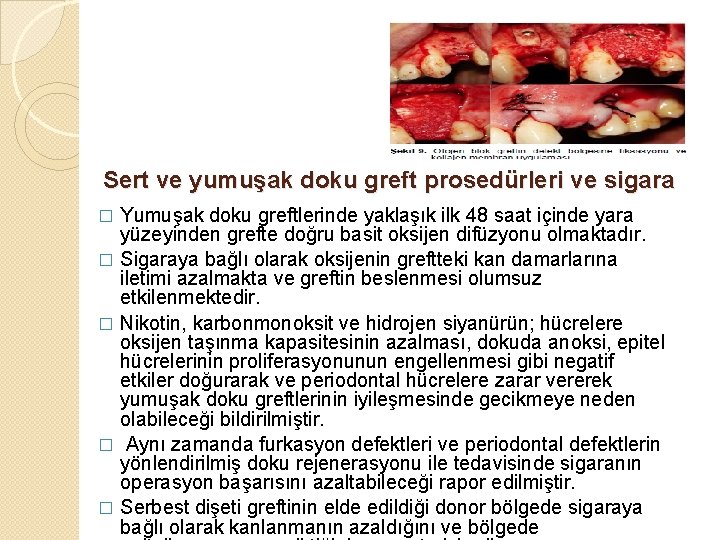 Sert ve yumuşak doku greft prosedürleri ve sigara Yumuşak doku greftlerinde yaklaşık ilk 48