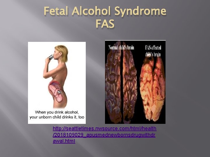 Fetal Alcohol Syndrome FAS http: //seattletimes. nwsource. com/html/health /2018109029_apusmednewbornsdrugwithdr awal. html 