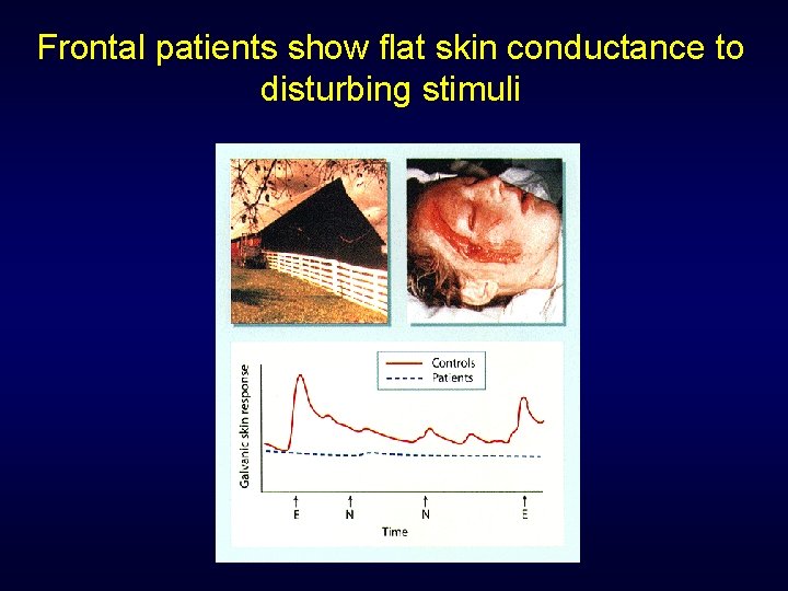 Frontal patients show flat skin conductance to disturbing stimuli Frontal patients show flat skin conductance to disturbing stimuli