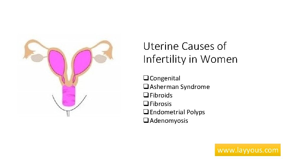 Uterine Causes of Infertility in Women q. Congenital q. Asherman Syndrome q. Fibroids q.