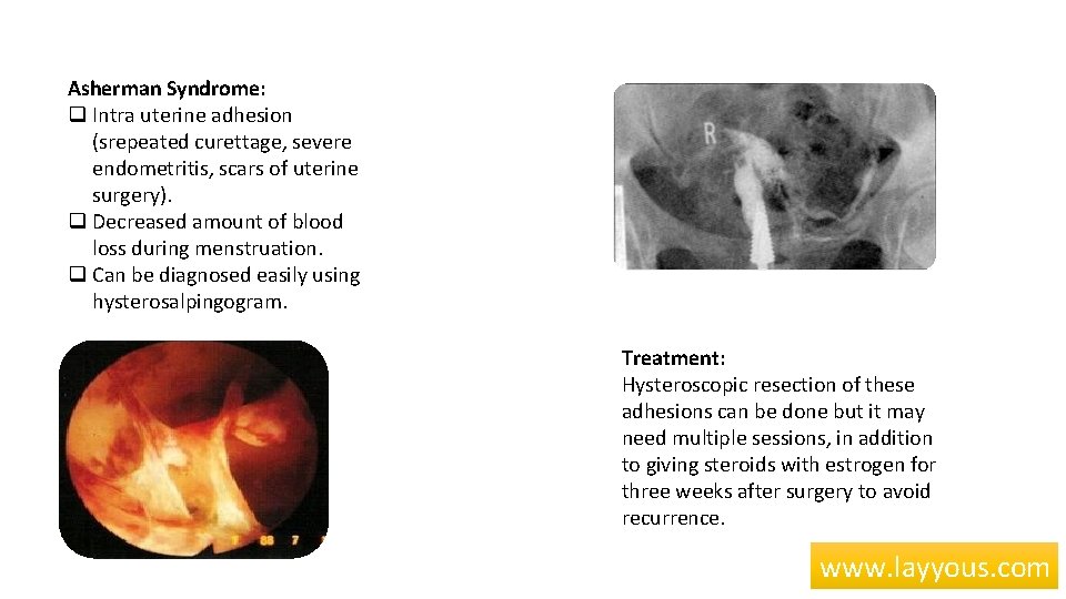 Asherman Syndrome: q Intra uterine adhesion (srepeated curettage, severe endometritis, scars of uterine surgery).