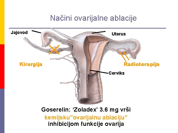 Načini ovarijalne ablacije Jajovod Uterus Kirurgija Radioterapija Cerviks Goserelin: ‘Zoladex’ 3. 6 mg vrši
