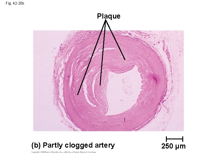 Fig. 42 -20 b Plaque (b) Partly clogged artery 250 µm 