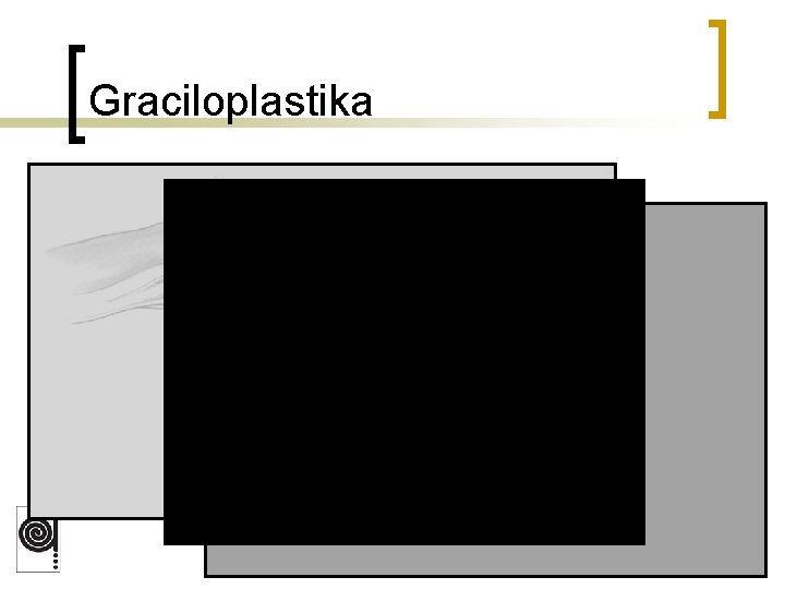 Graciloplastika 
