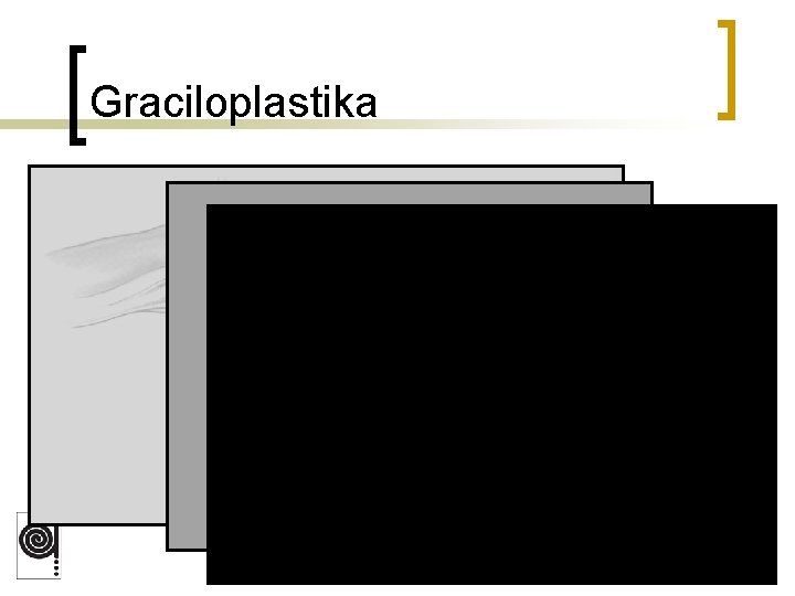 Graciloplastika 