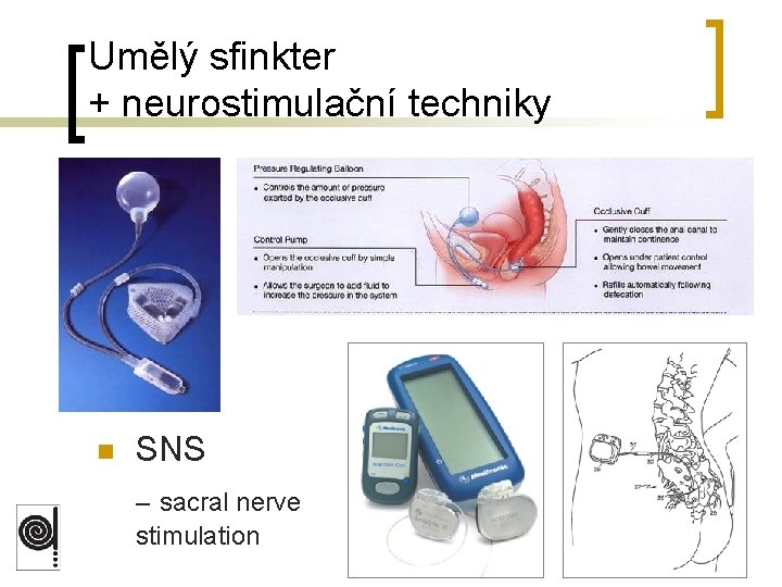 Umělý sfinkter + neurostimulační techniky n SNS – sacral nerve stimulation 