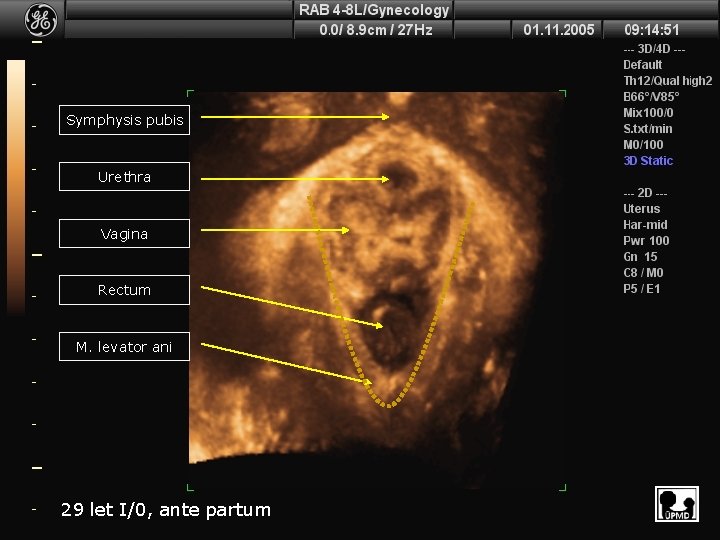 Symphysis pubis Urethra Vagina Rectum M. levator ani 29 let I/0, ante partum 