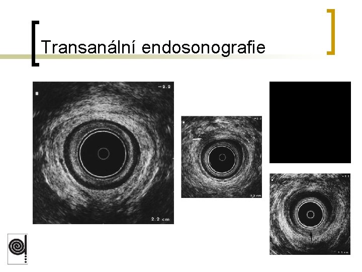 Transanální endosonografie 