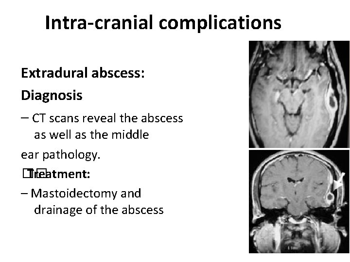 Intra-cranial complications Extradural abscess: Diagnosis – CT scans reveal the abscess as well as