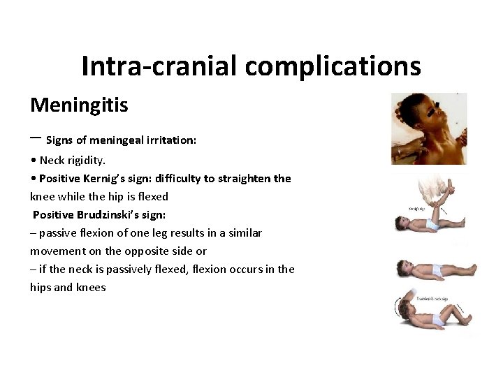 Intra-cranial complications Meningitis – Signs of meningeal irritation: • Neck rigidity. • Positive Kernig’s