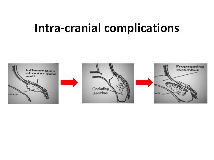 Intra-cranial complications 