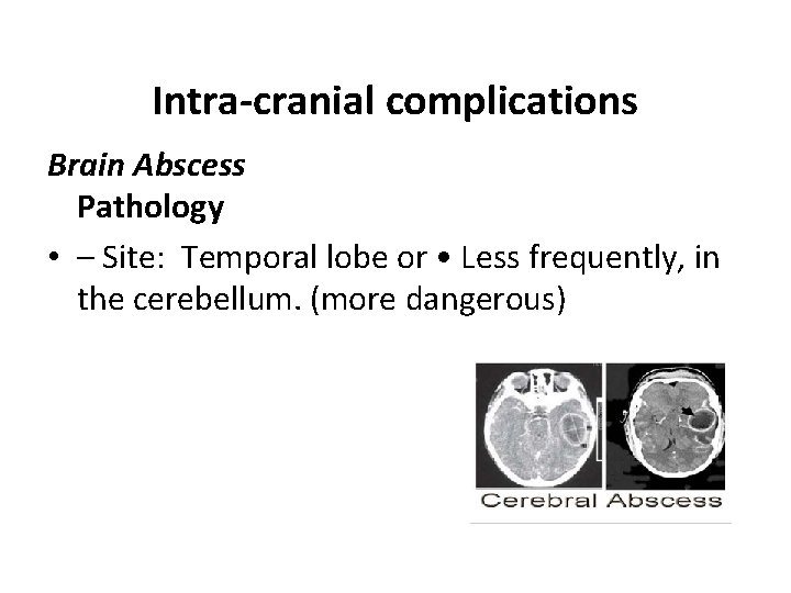 Intra-cranial complications Brain Abscess Pathology • – Site: Temporal lobe or • Less frequently,