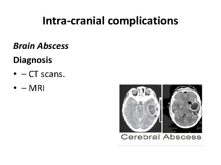 Intra-cranial complications Brain Abscess Diagnosis • – CT scans. • – MRI 