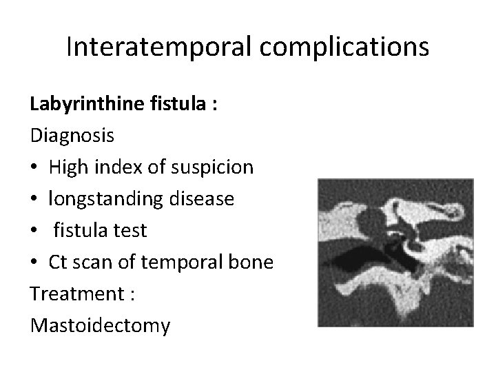 Interatemporal complications Labyrinthine fistula : Diagnosis • High index of suspicion • longstanding disease