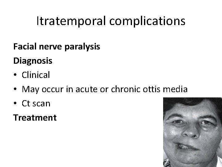 Itratemporal complications Facial nerve paralysis Diagnosis • Clinical • May occur in acute or