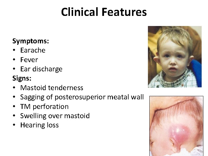Clinical Features Symptoms: • Earache • Fever • Ear discharge Signs: • Mastoid tenderness