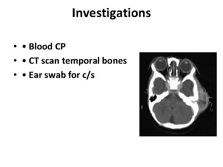 Investigations • • Blood CP • • CT scan temporal bones • • Ear