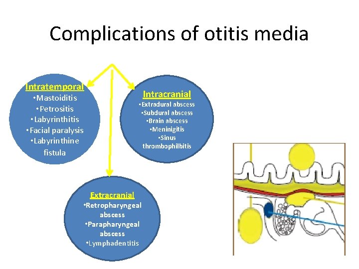 Complications of otitis media Intratemporal Intracranial • Mastoiditis • Petrositis • Labyrinthitis • Facial