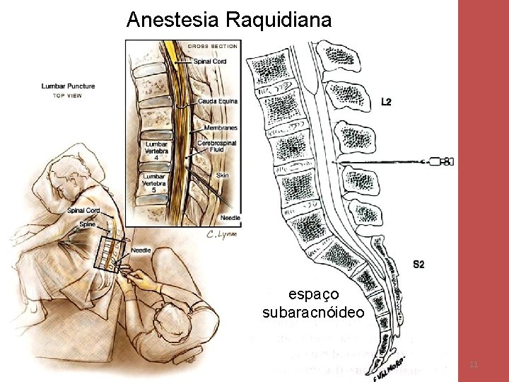 Anestesia Raquidiana espaço subaracnóideo 11 