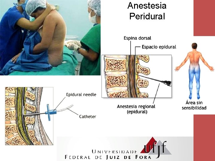 Anestesia Peridural 12 