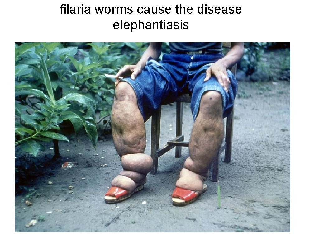 filaria worms cause the disease elephantiasis 