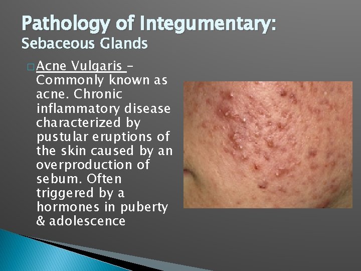 Pathology of Integumentary: Sebaceous Glands � Acne Vulgaris – Commonly known as acne. Chronic