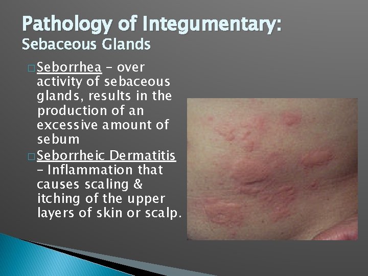 Pathology of Integumentary: Sebaceous Glands � Seborrhea – over activity of sebaceous glands, results