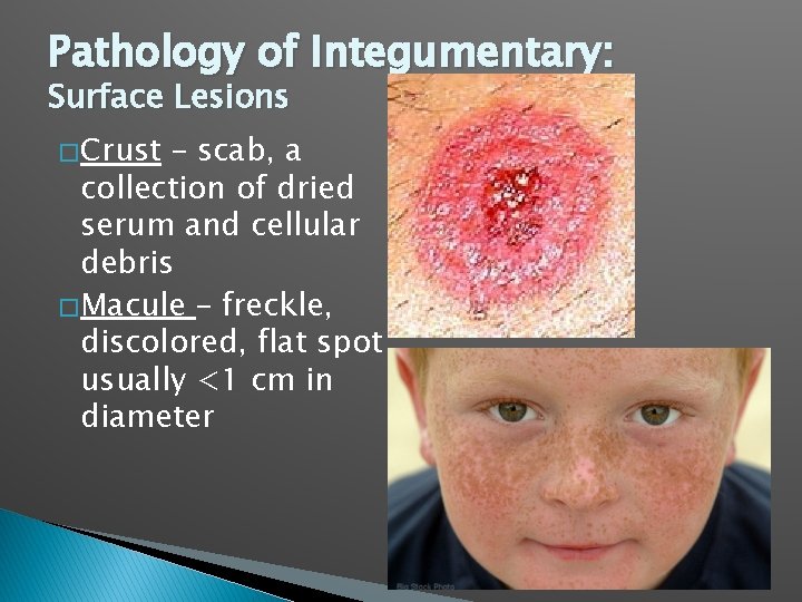 Pathology of Integumentary: Surface Lesions � Crust – scab, a collection of dried serum