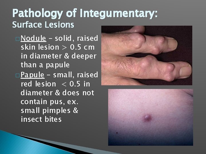 Pathology of Integumentary: Surface Lesions � Nodule – solid, raised skin lesion > 0.