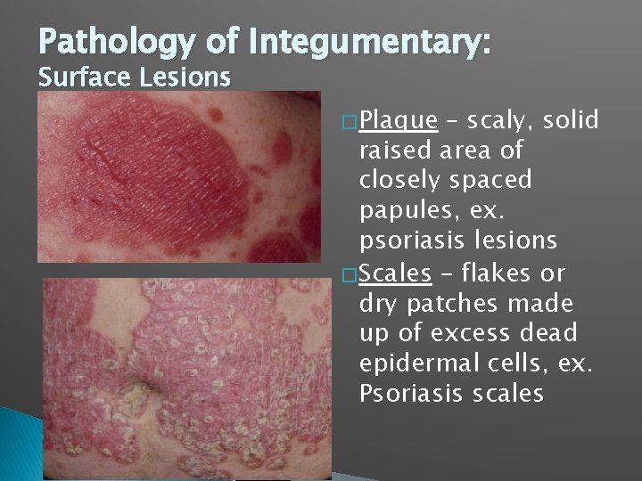 Pathology of Integumentary: Surface Lesions � Plaque – scaly, solid raised area of closely