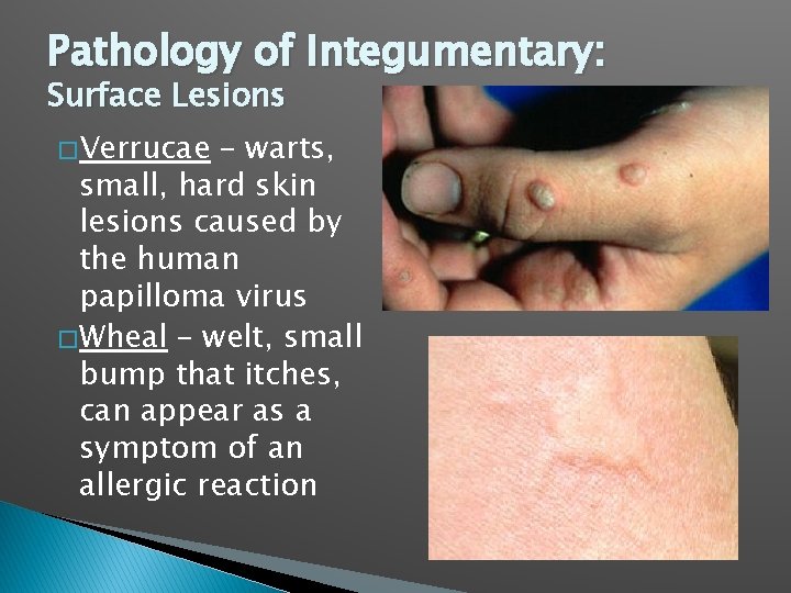 Pathology of Integumentary: Surface Lesions � Verrucae – warts, small, hard skin lesions caused