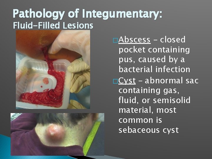 Pathology of Integumentary: Fluid-Filled Lesions � Abscess – closed pocket containing pus, caused by