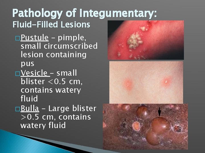 Pathology of Integumentary: Fluid-Filled Lesions � Pustule – pimple, small circumscribed lesion containing pus