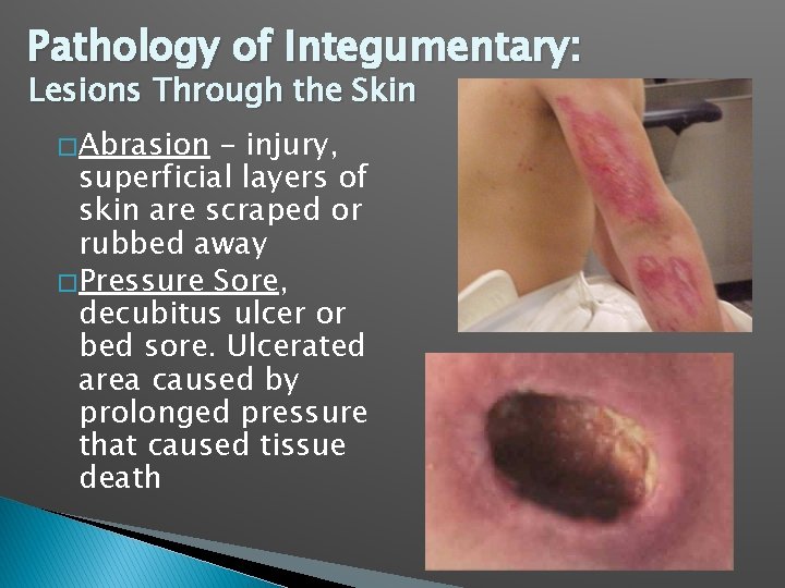 Pathology of Integumentary: Lesions Through the Skin � Abrasion – injury, superficial layers of