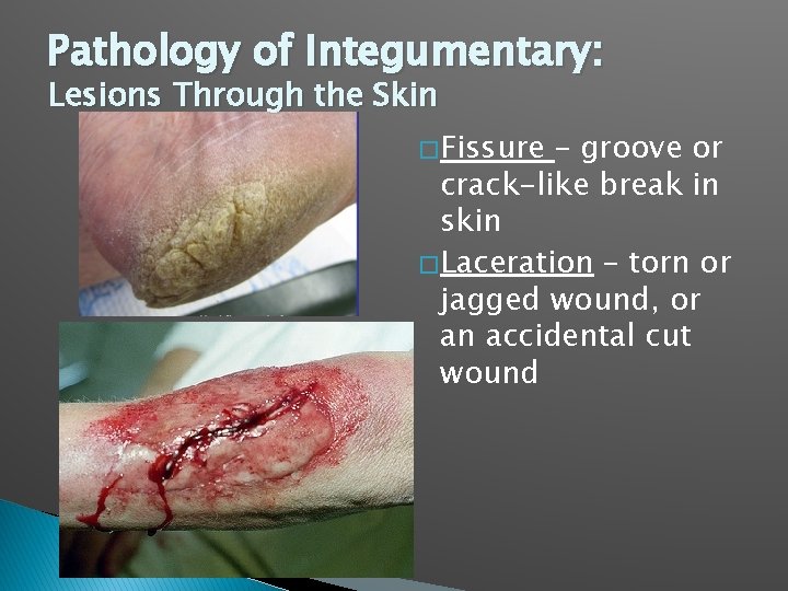 Pathology of Integumentary: Lesions Through the Skin � Fissure – groove or crack-like break