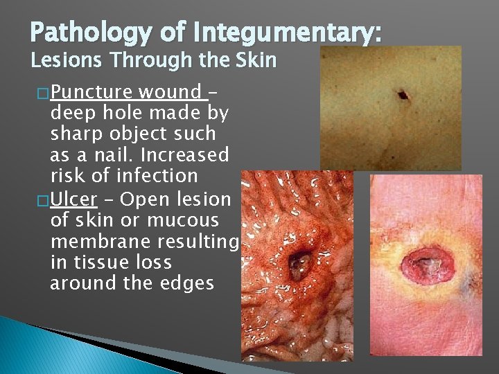 Pathology of Integumentary: Lesions Through the Skin � Puncture wound – deep hole made