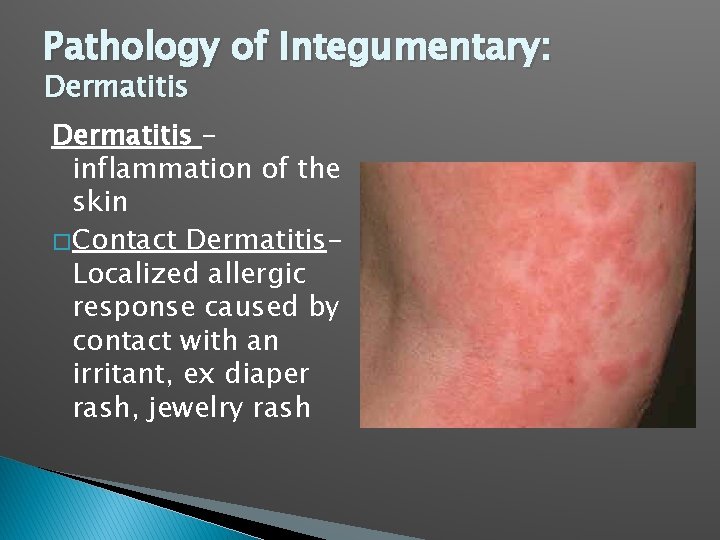 Pathology of Integumentary: Dermatitis – inflammation of the skin � Contact Dermatitis. Localized allergic