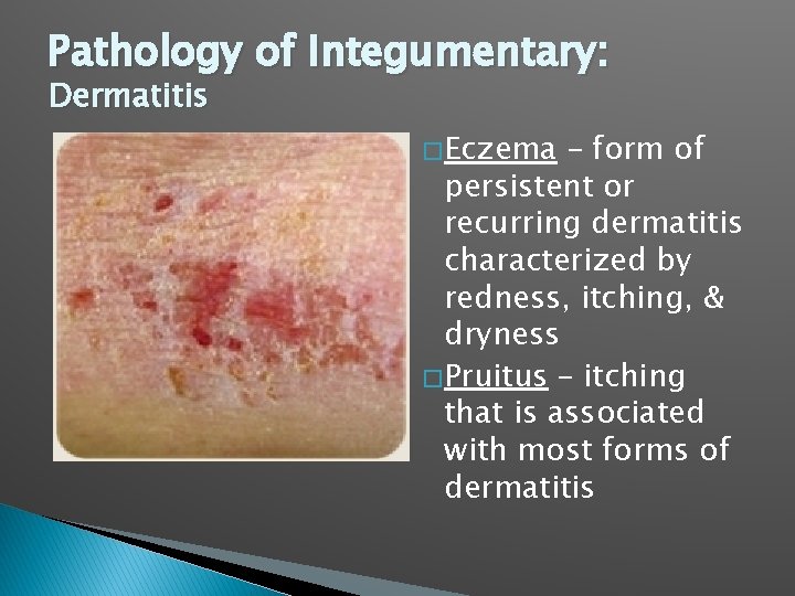 Pathology of Integumentary: Dermatitis � Eczema – form of persistent or recurring dermatitis characterized