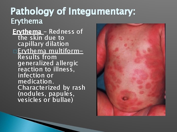 Pathology of Integumentary: Erythema – Redness of the skin due to capillary dilation �