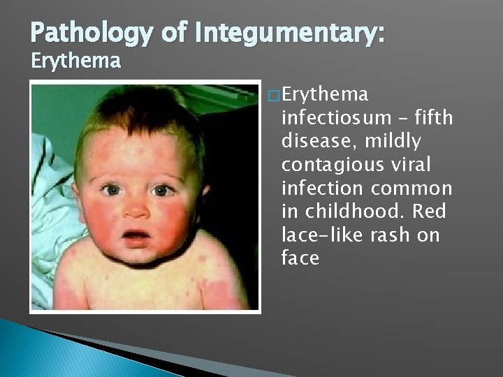 Pathology of Integumentary: Erythema � Erythema infectiosum – fifth disease, mildly contagious viral infection