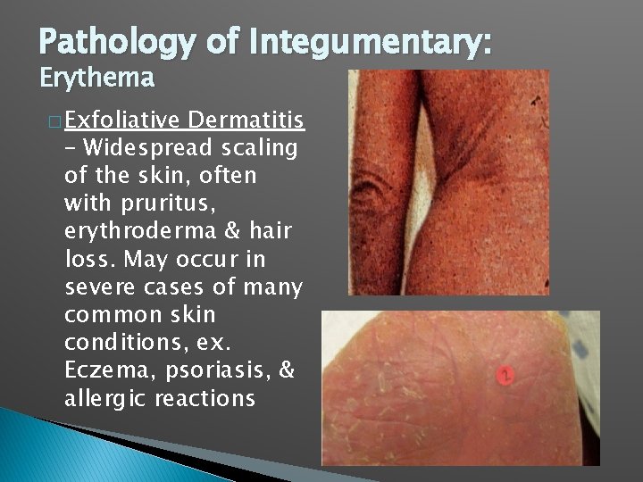Pathology of Integumentary: Erythema � Exfoliative Dermatitis – Widespread scaling of the skin, often