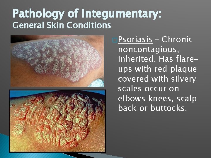 Pathology of Integumentary: General Skin Conditions � Psoriasis – Chronic noncontagious, inherited. Has flareups