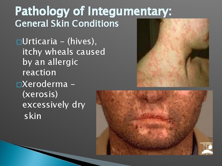 Pathology of Integumentary: General Skin Conditions � Urticaria – (hives), itchy wheals caused by