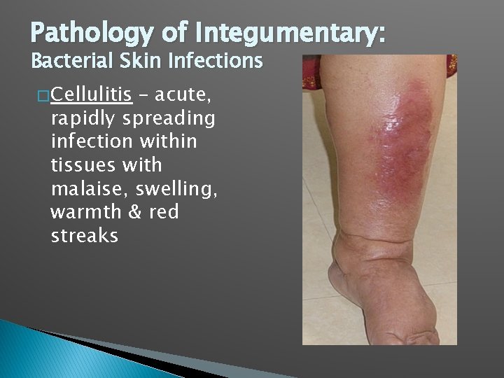 Pathology of Integumentary: Bacterial Skin Infections � Cellulitis – acute, rapidly spreading infection within