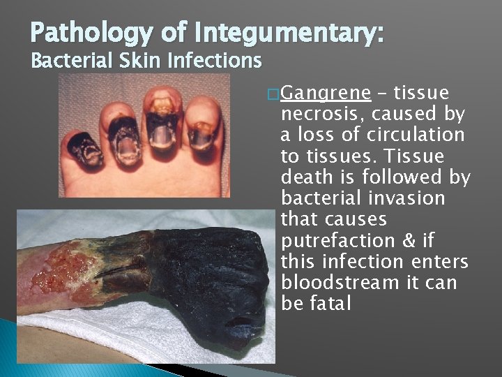 Pathology of Integumentary: Bacterial Skin Infections � Gangrene – tissue necrosis, caused by a